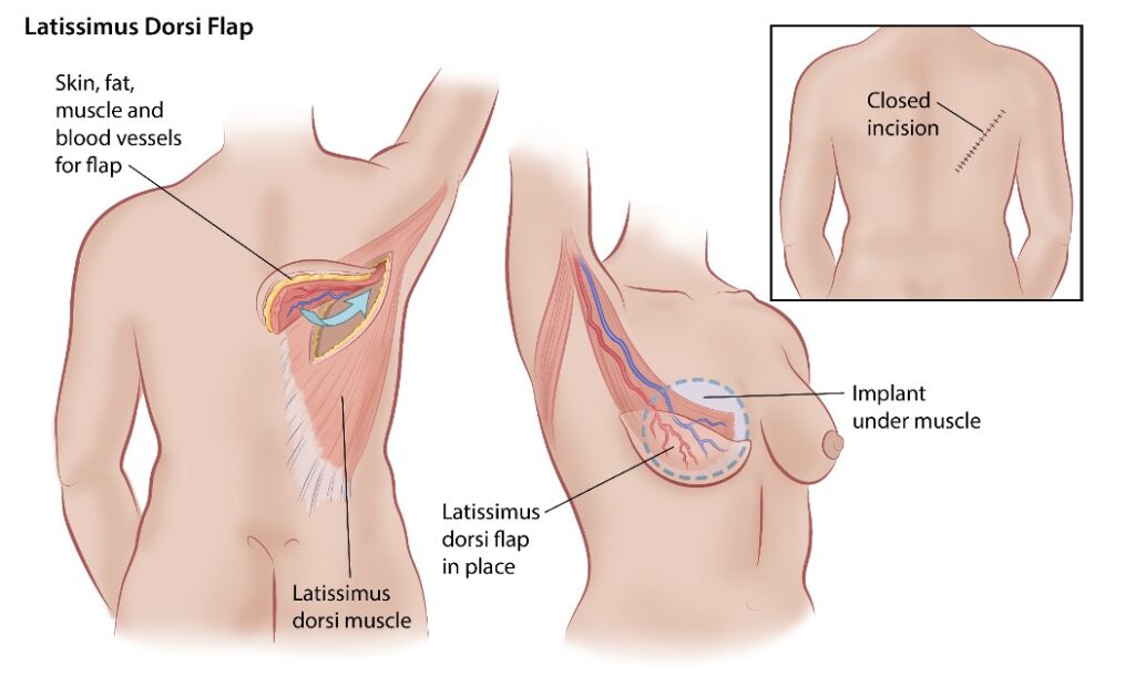 Breast reconstruction with latissimus dorsi and implant insertion