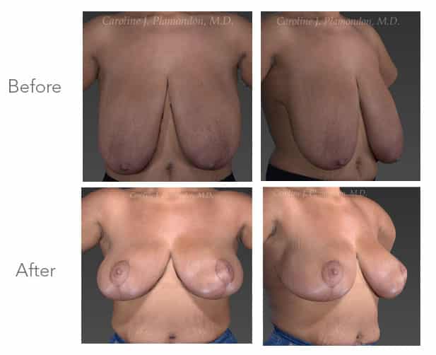 Images of chest before and after breast reduction surgery.