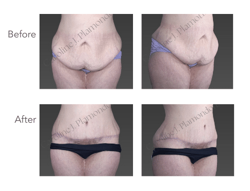 Before and after photos of a 46-year-old female's Panniculectomy procedure, showing 51 to 144 lbs weight loss.