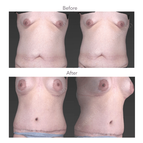 36-year-old-female-Abdominoplasty-Breast-Augmentation-Peri-Areolar-Lift-5-147-lbs-Watermarked-2