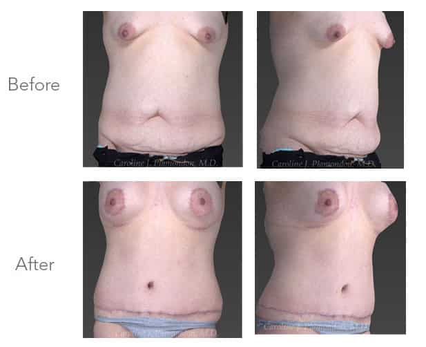 36-year-old-female-Abdominoplasty-Breast-Augmentation-Peri-Areolar-Lift-5-147-lbs-Watermarked-2
