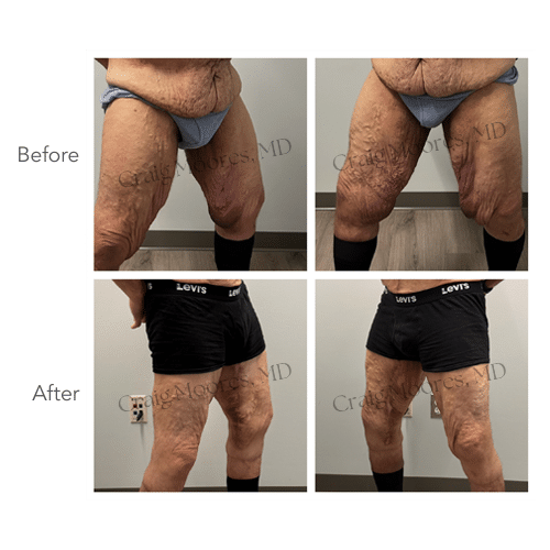 59 yo male 5'11 227 lb thighplasty